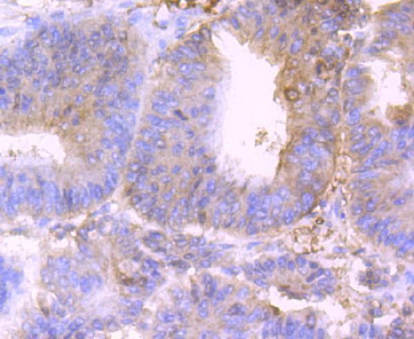 Immunohistochemical analysis of paraffin-embedded human colon cancer tissue using anti-BST2 antibody