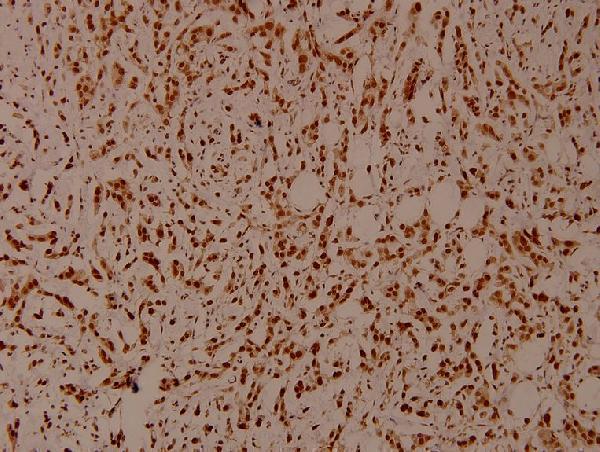 Immunohistochemistry (IHC) analyzes of SHP-1 (phospho-Y536) polyclonal antibody in paraffin-embedded human breast carcinoma tissue at 1:100