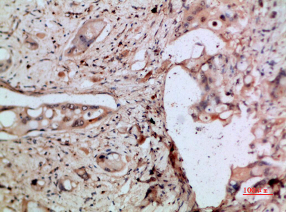 Immunohistochemical analysis of paraffin-embedded human-pancreas-cancer, antibody was diluted at 1:200
