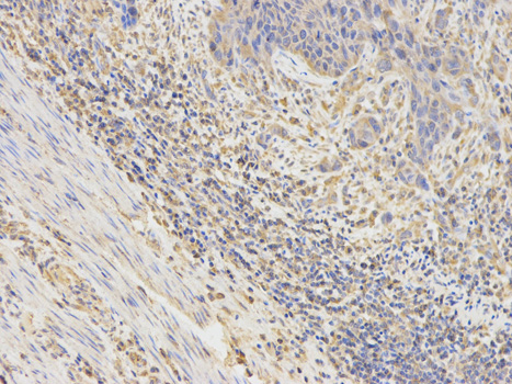 Immunohistochemistry of paraffin-embedded human liver cancer using OPTN Rabbit pAb  at dilution of 1:100 