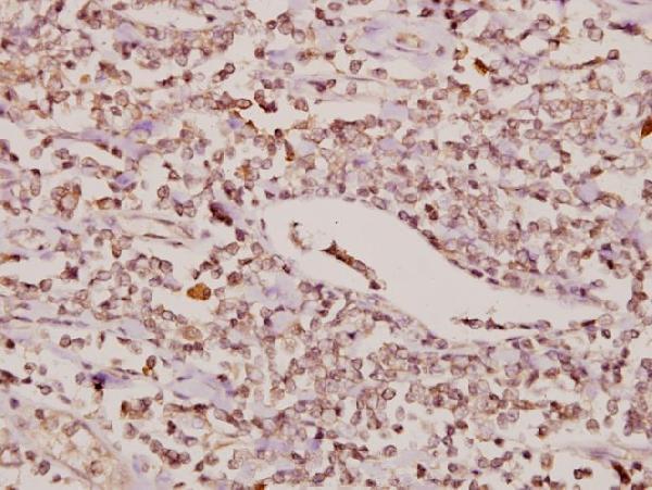 Immunohistochemistry (IHC) analyzes of FoxC1/2 (K138) pAb in paraffin-embedded human tonsil carcinoma tissue at 1:50