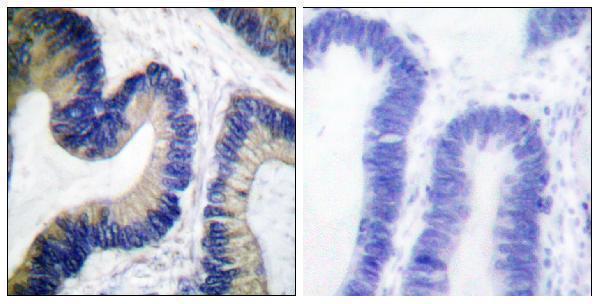 Immunohistochemistry analysis of paraffin-embedded human colon carcinoma, using 4E-BP1 (Phospho-Ser64) Antibody