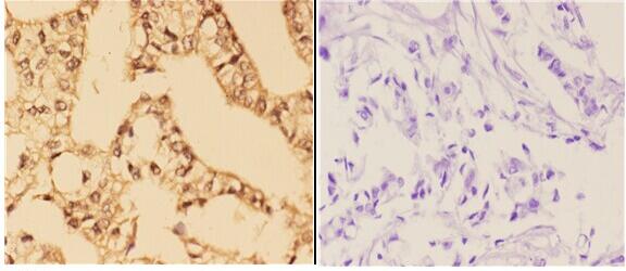 Immunohistochemistry (IHC) analyzes of 4E-BP1 (phospho-S65) pAb in paraffin-embedded human breast carcinoma tissue at 1:50,showing cytoplasmic and nuclear staining
