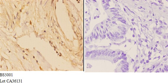 Immunohistochemistry (IHC) analyzes of 4E-BP1 (phospho-S65) pAb in paraffin-embedded human colon carcinoma tissue at 1:50,showing cytoplasmic and nuclear staining