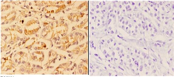 Immunohistochemistry (IHC) analyzes of 4E-BP1 (phospho-S65) pAb in paraffin-embedded human stomach carcinoma tissue at 1:50,showing cytoplasmic and nuclear staining