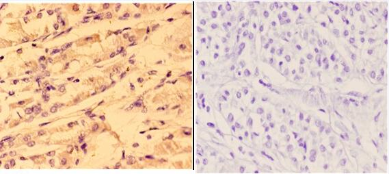 Immunohistochemistry (IHC) analyzes of 4E-BP1 (phospho-T37) pAb in paraffin-embedded human stomach carcinoma tissue at 1:50,showing cytoplasmic and nuclear staining