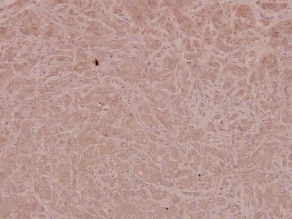 Immunohistochemistry (IHC) analyzes of p-4E-BP1 (T46) pAb in paraffin-embedded human breast carcinoma tissue at 1:100