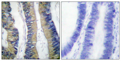 Immunohistochemical analysis of paraffin-embedded Human colon cancer
