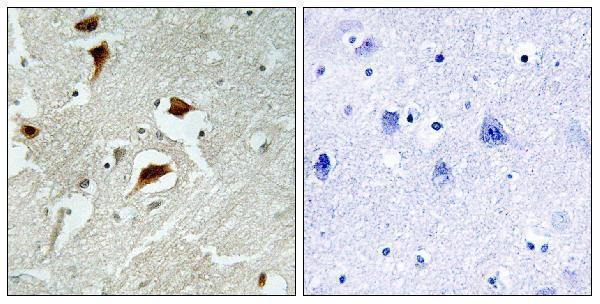 Immunohistochemistry analysis of paraffin-embedded human brain carcinoma, using 4E-BP1 (Phospho-Thr69) Antibody