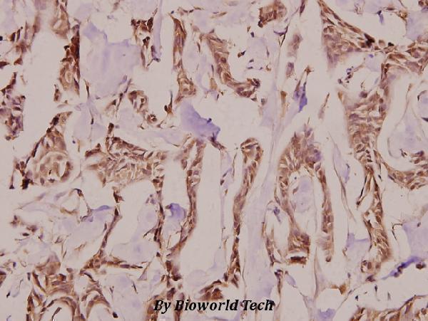 Immunohistochemistry (IHC) analyzes of Follistatin (R163) pAb in paraffin-embedded human breast carcinoma tissue at 1:100