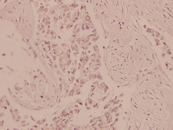 Immunohistochemistry (IHC) analyzes of AMPKα1/2 (D168) pAb in paraffin-embedded human breast carcinoma tissue at 1:100