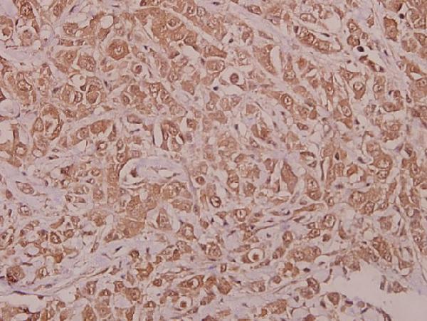 Immunohistochemistry (IHC) analyzes of p-AMPKα1 (S486) pAb in paraffin-embedded human colorectal carcinoma tissue at 1:50