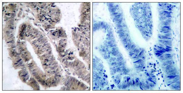 Immunohistochemistry analysis of paraffin-embedded human colon carcinoma, using AMPK1 (Phospho-Ser485) Antibody