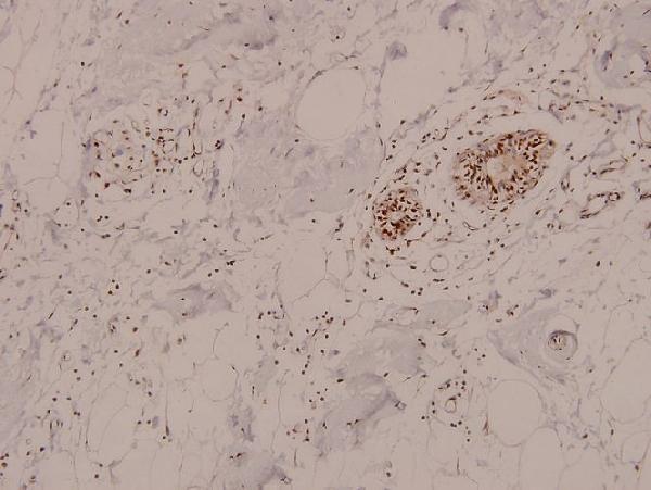 Immunohistochemistry (IHC) analyzes of p-AMPKα1/2 (T183/172) pAb in paraffin-embedded human breast carcinoma tissue at 1:100