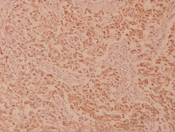 Immunohistochemistry (IHC) analyzes of MEK2 (R388) pAb in paraffin-embedded human breast carcinoma tissue at 1:100