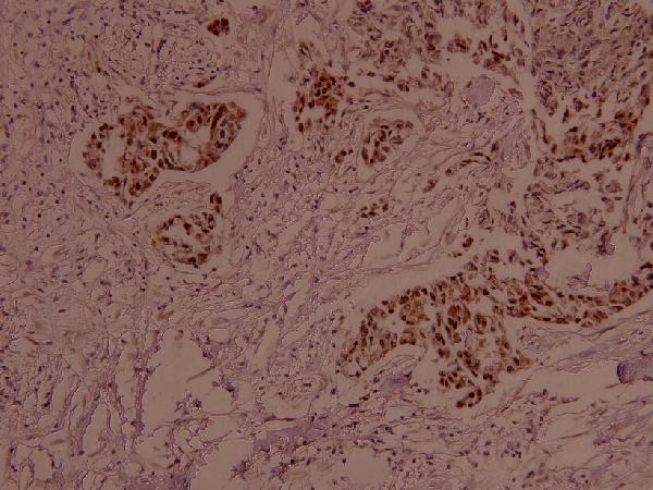 Immunohistochemistry (IHC) analyzes of p-MEK 2(T394) pAb in paraffin-embedded human breast carcinoma tissue at 1:100
