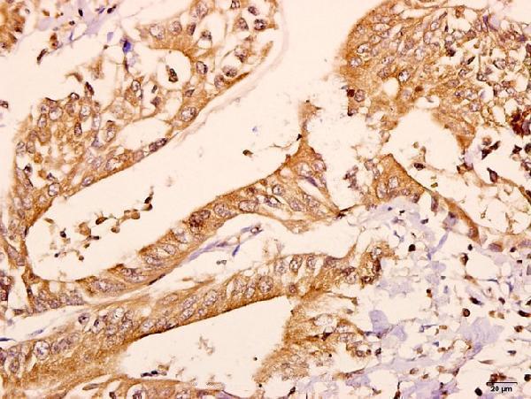 Immunohistochemistry (IHC) analyzes of CNPase (A108) pAb in paraffin-embedded human colorectal carcinoma tissue at 1:50