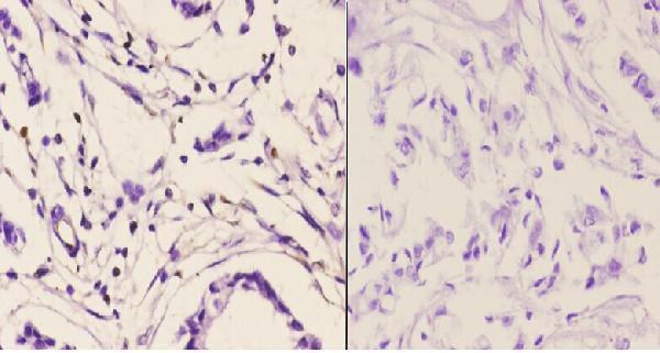 Immunohistochemistry (IHC) analyzes of PMS2 (D483) pAb in paraffin-embedded human breast carcinoma tissue at 1:50