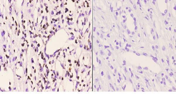 Immunohistochemistry (IHC) analyzes of PMS2 (D483) pAb in paraffin-embedded human kidney carcinoma tissue at 1:50