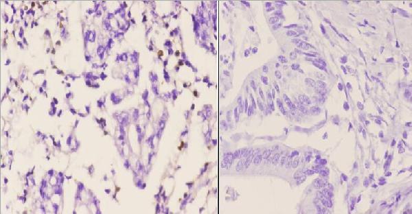 Immunohistochemistry (IHC) analyzes of PMS2 (D483) pAb in paraffin-embedded human colon carcinoma tissue at 1:50