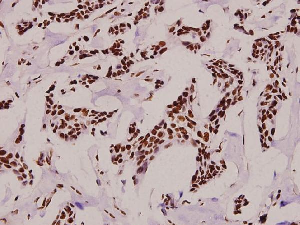 Immunohistochemistry (IHC) analyzes of p-Rpb1 (S1619) pAb in paraffin-embedded human breast carcinoma tissue at 1:100