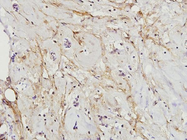 Immunohistochemistry (IHC) analyzes of Paxillin (L25) pAb in paraffin-embedded human breast carcinoma tissue at 1:100