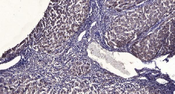 Immunohistochemical analysis of paraffin-embedded human liver cancer