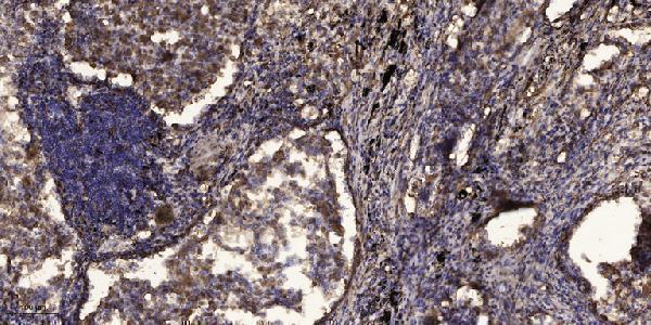 Immunohistochemical analysis of paraffin-embedded human Squamous cell carcinoma of lung