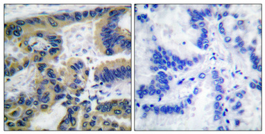 Immunohistochemistry analysis of paraffin-embedded human lung carcinoma tissue, using Caspase 7 (Cleaved-Asp198) Antibody