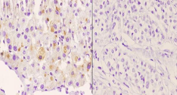 Immunohistochemistry (IHC) analyzes of p-Rsk-1 (S380) pAb in paraffin-embedded human liver carcinoma tissue at 1:50