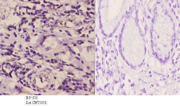 Immunohistochemistry (IHC) analyzes of p-Rsk-1 (S380) pAb in paraffin-embedded human esophageal carcinoma tissue at 1:50