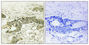 Immunohistochemical analysis of paraffin-embedded Human colon cancer