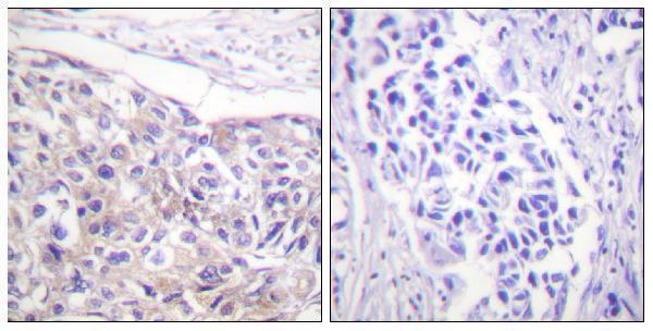 Immunohistochemistry analysis of paraffin-embedded human breast carcinoma, using p90 RSK (Phospho-Thr573) Antibody