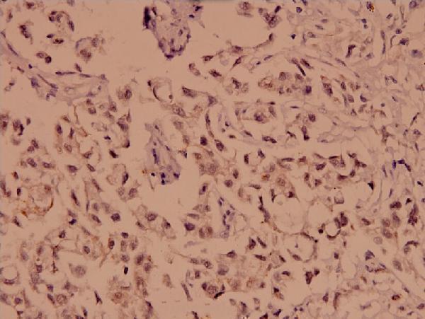 Immunohistochemistry (IHC) analyzes of Chk1 (N311) pAb in paraffin-embedded human breast carcinoma tissue at 1:100