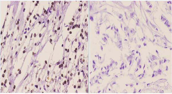 Immunohistochemistry (IHC) analyzes of p-Chk1 (S317) pAb in paraffin-embedded human breast carcinoma tissue at 1:50