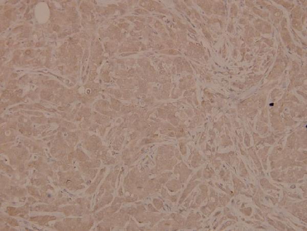 Immunohistochemistry (IHC) analyzes of p-Chk1 (S345) pAb in paraffin-embedded human breast carcinoma tissue at 1:100