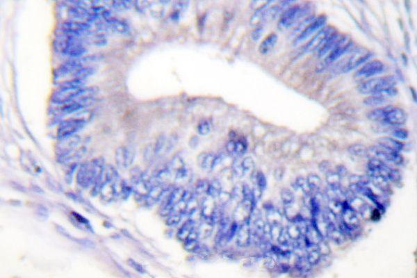 Immunohistochemistry (IHC) analyzes of p-PYK2 (Y580) pAb in paraffin-embedded human colon cancer tissue