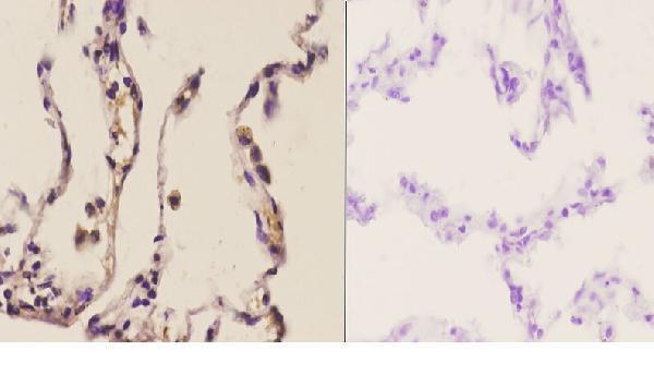 Immunohistochemistry (IHC) analyzes of NOS1 (Y846) pAb in paraffin-embedded human lung carcinoma tissue at 1:50