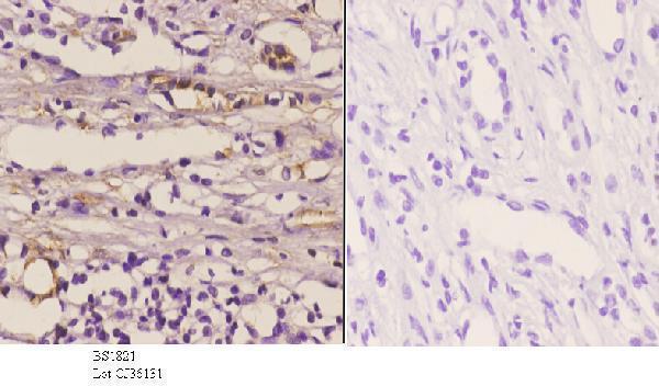 Immunohistochemistry (IHC) analyzes of NOS1 (Y846) pAb in paraffin-embedded human kidney carcinoma tissue at 1:50