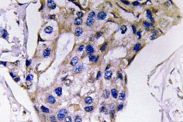 Immunohistochemistry (IHC) analyzes of IL-5 (S92) pAb in paraffin-embedded human breast carcinoma tissue