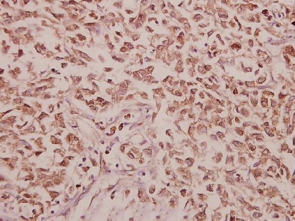 Immunohistochemistry (IHC) analyzes of CCK (V46) pAb in paraffin-embedded human colorectal carcinoma tissue at 1:50