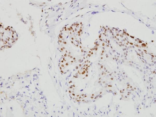 Immunohistochemistry (IHC) analyzes of C/EBP-β (S229/182) pAb in paraffin-embedded human breast carcinoma tissue at 1:100