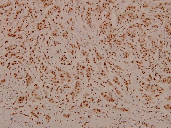 Immunohistochemistry (IHC) analyzes of p-C/EBP-β (T235/188) pAb in paraffin-embedded human breast carcinoma tissue at 1:100