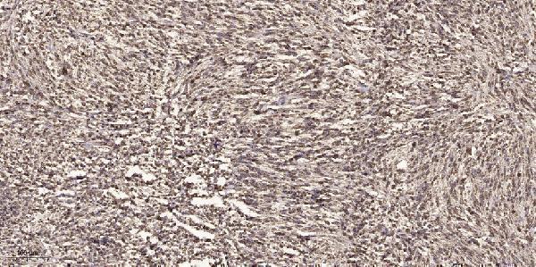 Immunohistochemical analysis of paraffin-embedded human small intestinal carcinoma tissue