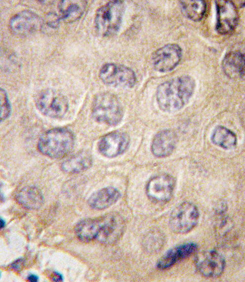 Formalin-fixed and paraffin-embedded human hepatocarcinoma tissue reacted with EDA antibody (N-term) , which was peroxidase-conjugated to the secondary antibody, followed by DAB staining