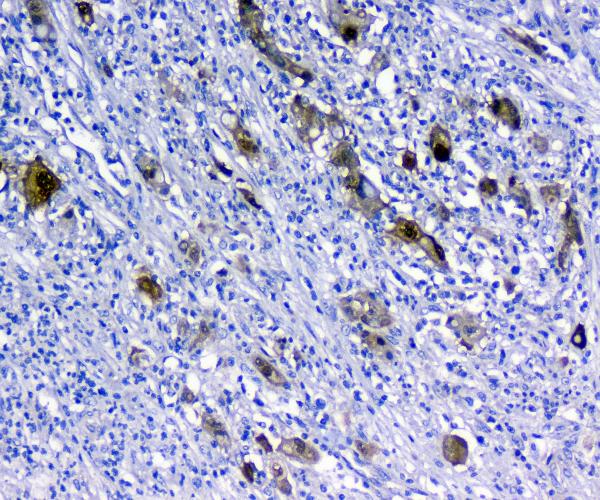 IHC analysis of 14-3-3 sigma using anti-14-3-3 sigma antibody (A01127). 14-3-3 sigma was detected in paraffin-embedded section of human rectal cancer tissues. Heat mediated antigen retrieval was performed in citrate buffer (pH6, epitope retrieval solution) for 20 mins. The tissue section was blocked with 10% goat serum. The tissue section was then incubated with 1μg/ml rabbit anti-14-3-3 sigma Antibody (A01127) overnight at 4°C. Biotinylated goat anti-rabbit IgG was used as secondary antibody and incubated for 30 minutes at 37°C. The tissue section was developed using Strepavidin-Biotin-Complex (SABC)(Catalog # SA1022) with DAB as the chromogen.