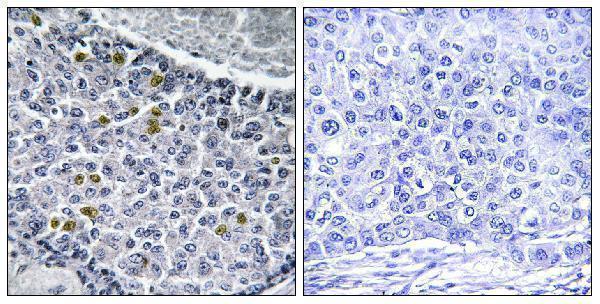 Immunohistochemistry analysis of paraffin-embedded human breast carcinoma, using MAD1 (Phospho-Ser428) Antibody