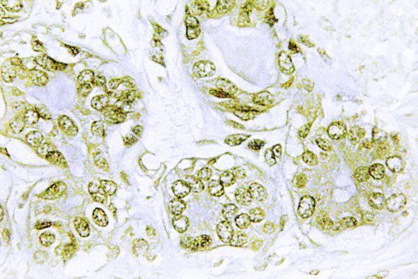 Immunohistochemistry (IHC) analyzes of p-IκB-α (Y42) pAb in paraffin-embedded human breast carcinoma tissue