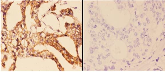 Immunohistochemistry (IHC) analyzes of 14-3-3 ζ (V52) pAb in paraffin-embedded human breast carcinoma tissue at 1:50,showing cytoplasmic and nuclear staining