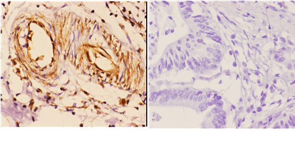 Immunohistochemistry (IHC) analyzes of 14-3-3 ζ (V52) pAb in paraffin-embedded human colon carcinoma tissue at 1:50,showing cytoplasmic and nuclear staining